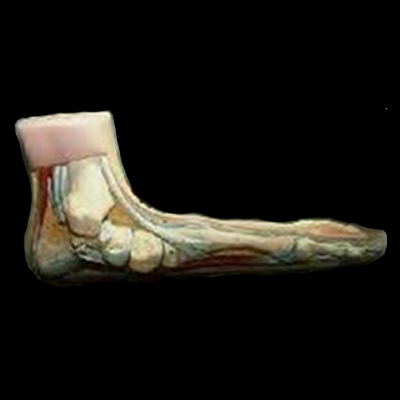 MRI of a foot with no arch